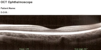 Das OCT ist unverzichtbar bei der Diagnostik und Verlaufskontrolle von Maculaerkrankungen und des Grünen Stars.