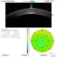 
Die Hornhautdickenmessung Pachymetrie ist ebenfalls ein wichtiger Faktor bei der Erkennung des Grünen Stars.