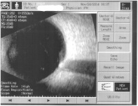 Mit dem Ultraschallgerät kann man ins und hinter das Auge blicken, auch wenn die Linse trüb ist und so Netzhautablösungen oder Tumore erkennen.