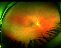 Mit der optomap Netzhautuntersuchung kann ohne erweiternde Augentropfen der Augenhintergrund untersucht und dokumentiert werden.